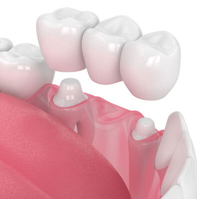 crowns extracted tooth